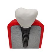 Implante Dental Análise Modelo Dentário Dente 3D Anatomia